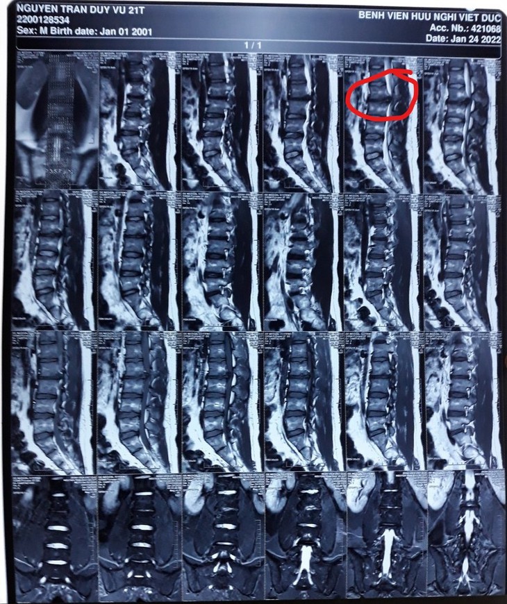 Cảnh báo tình trạng thoát vị đĩa đệm ở người trẻ! - Ảnh 1. Cảnh báo tình trạng thoát vị đĩa đệm ở người trẻ! - Ảnh 1.