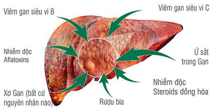 Ung thư gan nguyên phát: Phân loại, biểu hiện và các yếu tố nguy cơ - Ảnh 1.