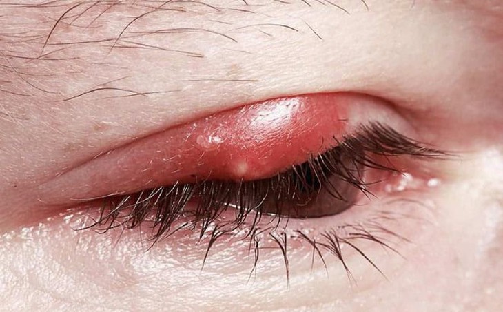 Nhận biết và điều trị chắp lẹo mắt tránh nguy cơ tái phát - Ảnh 2.