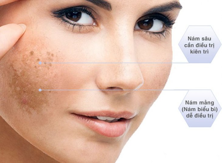 Sử dụng tretinoin trị nám da sai gây hại gì? - Ảnh 1.