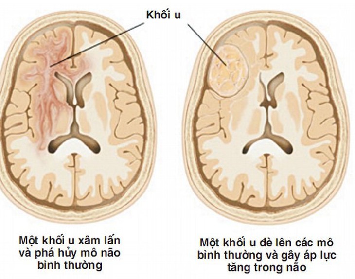Ngày U não thế giới: Khối u não có thể gây trầm cảm, thay đổi tính cách? - Ảnh 4.