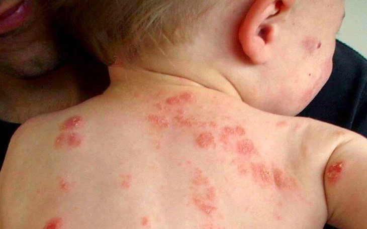 Mùa hè cảnh giác với chốc lở ngoài da ở trẻ em