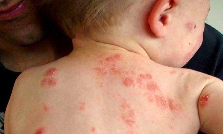Mùa hè cảnh giác với chốc lở ngoài da ở trẻ em - Ảnh 2.