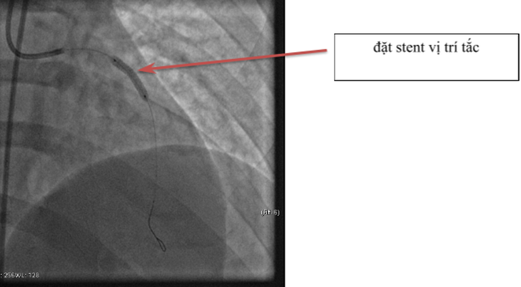 Cảnh báo: Nhồi máu cơ tim ở người trẻ - Ảnh 1.