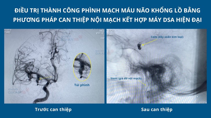 Điều trị thành công phình mạch máu não khổng lồ bằng phương pháp can thiệp nội mạch kết hợp máy DSA hiện đại - Ảnh 1. Điều trị thành công phình mạch máu não khổng lồ bằng phương pháp can thiệp nội mạch kết hợp máy DSA hiện đại - Ảnh 1.