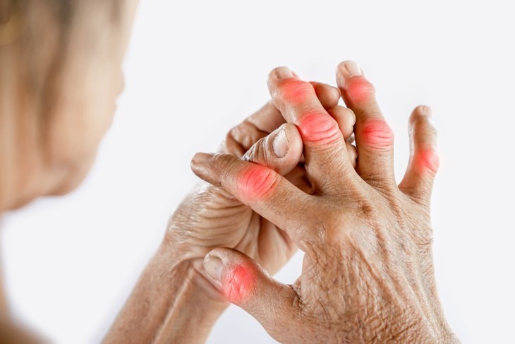 Gout là gì? Triệu chứng và cách điều trị gout - Ảnh 1. Gout là gì? Triệu chứng và cách điều trị gout - Ảnh 1.