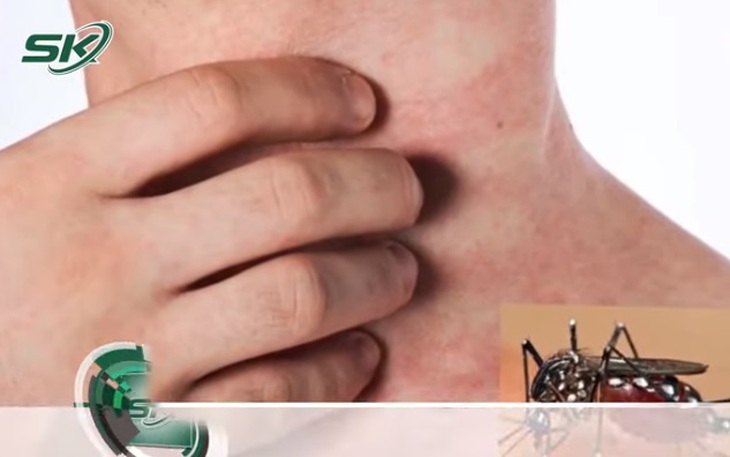Lý giải nguyên nhân sốt xuất huyết đổ dồn về TP. HCM
