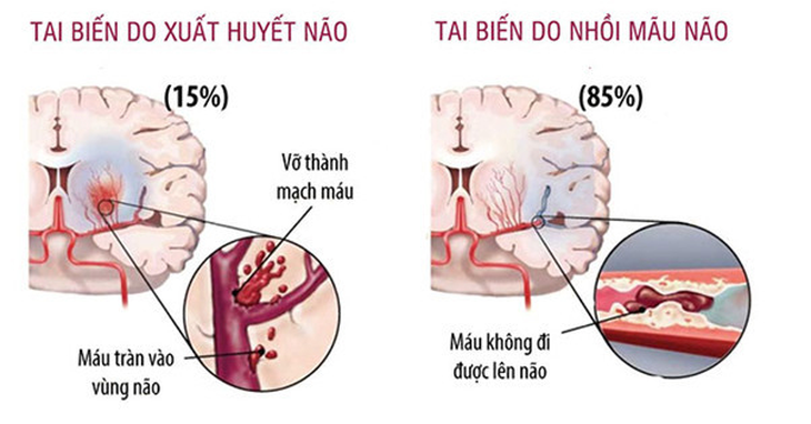 Đột quỵ là gì? Khi nào cần đến bệnh viện để điều trị? - Ảnh 3.