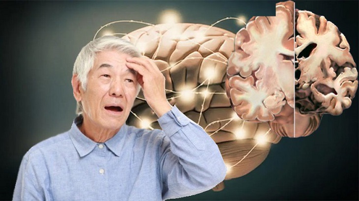 Thuốc tăng động có thể cải thiện triệu chứng của bệnh Alzheimer - Ảnh 1. Thuốc tăng động có thể cải thiện triệu chứng của bệnh Alzheimer - Ảnh 1.
