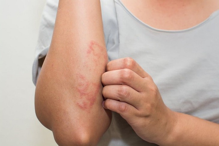 Hầu hết bệnh da liễu điều khiến bạn cảm thấy khó chịu và tự ti với làn da kém hoàn hảo của mình. Ảnh minh họa Hầu hết bệnh da liễu điều khiến bạn cảm thấy khó chịu và tự ti với làn da kém hoàn hảo của mình. Ảnh minh họa