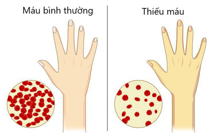 Điều trị thiếu máu như thế nào?