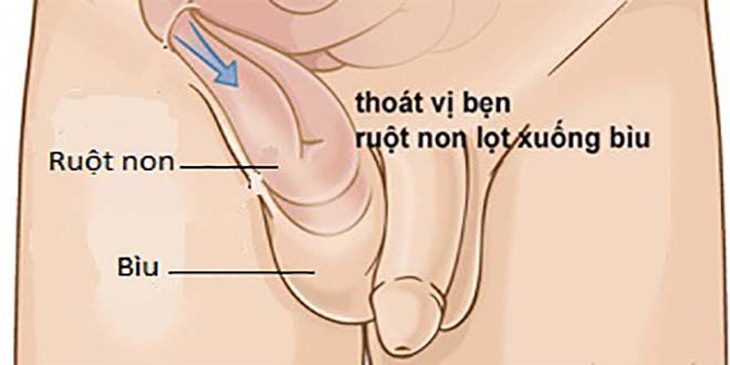 Thoát vị bẹn ở trẻ nhỏ có nguy hiểm không? - Ảnh 2.