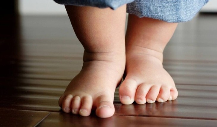 Một số tật về phát triển vận động thường gặp ở trẻ mà cha mẹ nên biết để phát hiện sớm - Ảnh 3. Một số tật về phát triển vận động thường gặp ở trẻ mà cha mẹ nên biết để phát hiện sớm - Ảnh 3.