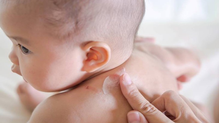 4 bệnh về da ở trẻ nhỏ thường gặp mùa nắng nóng - Ảnh 1. 4 bệnh về da ở trẻ nhỏ thường gặp mùa nắng nóng - Ảnh 1.