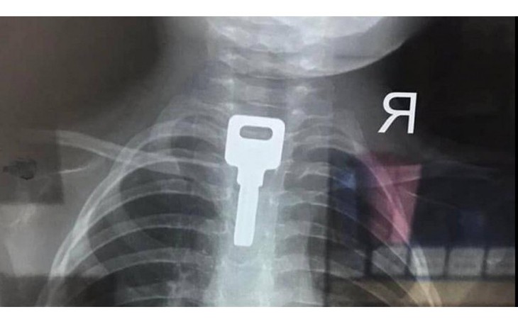 Bị giật mình, bé trai 2 tuổi nuốt chiếc chìa khóa "khủng" vào thực quản