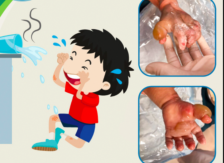 Con bị bỏng, cha mẹ vô tình làm hại con chỉ vì nghe lời người quen - Ảnh 1. Con bị bỏng, cha mẹ vô tình làm hại con chỉ vì nghe lời người quen - Ảnh 1.