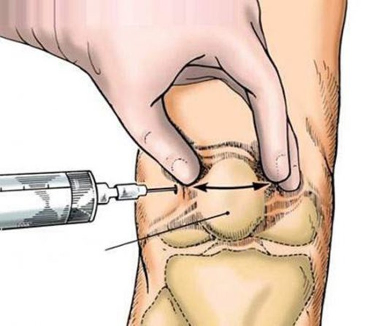 Việc điều trị tràn dịch khớp gối phụ thuộc vào mức độ và giai đoạn của bệnh để có những phương pháp điều trị cụ thể. Ảnh minh họa Việc điều trị tràn dịch khớp gối phụ thuộc vào mức độ và giai đoạn của bệnh để có những phương pháp điều trị cụ thể. Ảnh minh họa