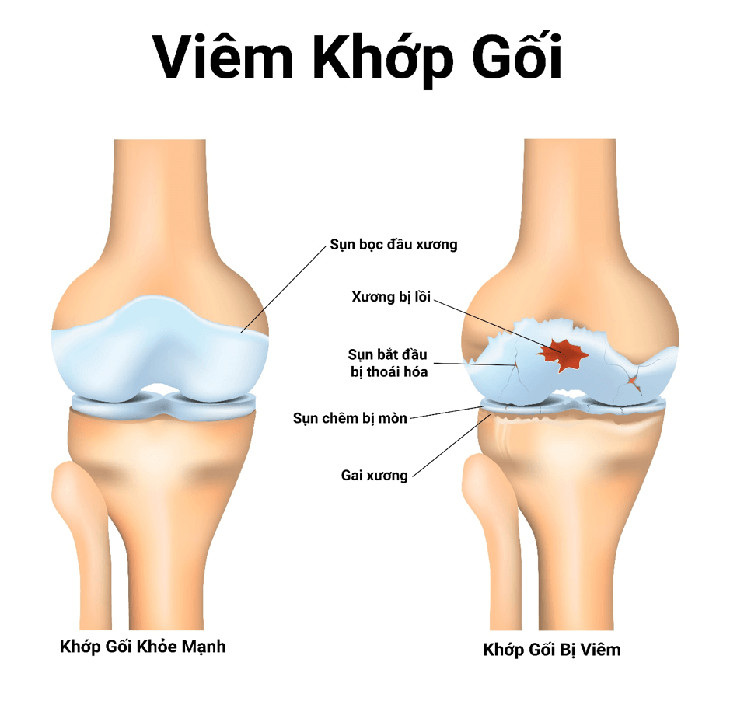 Tràn dịch khớp gối là hiện tượng lượng dịch trong khớp gối tăng bất thường, thậm chí có mủ sau khi bị va đập mạnh. Tràn dịch khớp gối là hiện tượng lượng dịch trong khớp gối tăng bất thường, thậm chí có mủ sau khi bị va đập mạnh.