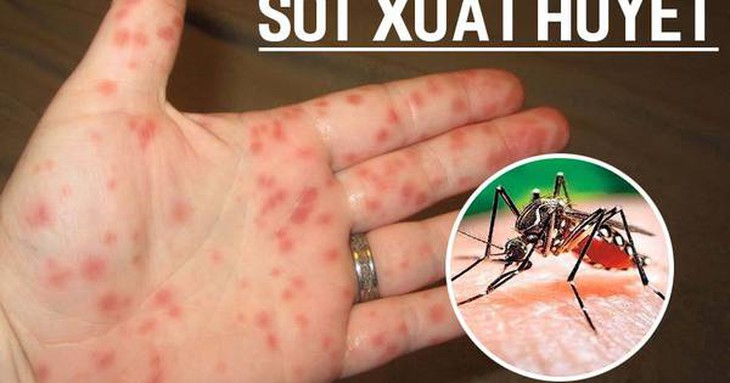 Sốt xuất huyết: Điều trị bằng Đông Y vào giai đoạn nào tốt nhất?