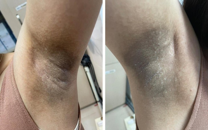 Nách đen sì vì tin theo quảng cáo làm trắng ở spa