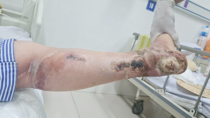Một ngư dân hoại tử chân hôi thối, thủ phạm là căn bệnh không lây nhưng rất nguy hiểm - Ảnh 1.