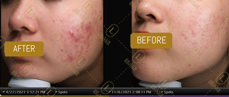 Tiêu chí lựa chọn địa chỉ điều trị mụn - Ảnh 3.