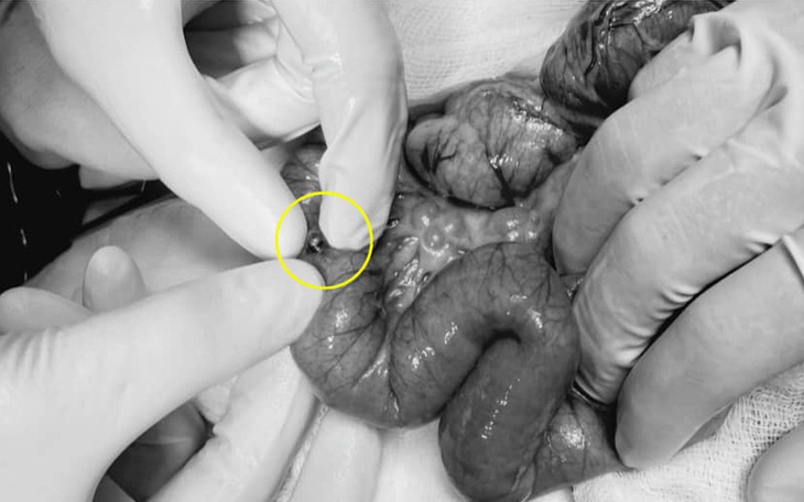 Bé gái 3 tuổi thủng ruột vì món đồ chơi quen thuộc - Ảnh 1. Bé gái 3 tuổi thủng ruột vì món đồ chơi quen thuộc - Ảnh 1.