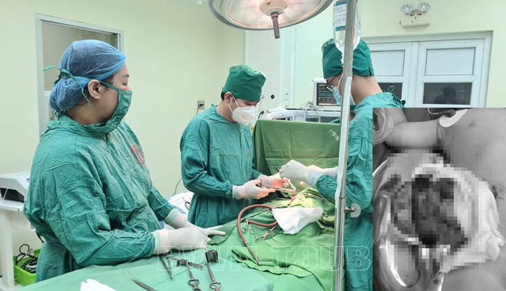 Kích hoạt báo động đỏ cứu sống cháu bé 17 tháng bị mảnh vỡ chậu rửa tay đâm xuyên bụng - Ảnh 1.