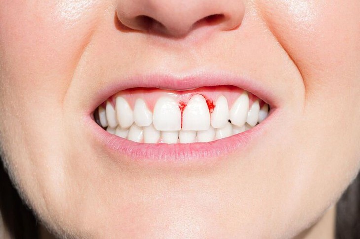 Viêm lợi, điều trị và phòng tránh bằng cách nào? - Ảnh 1. Viêm lợi, điều trị và phòng tránh bằng cách nào? - Ảnh 1.