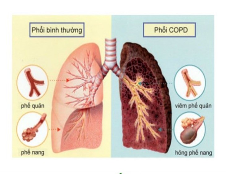 Phòng ngừa và hạn chế đợt cấp của bệnh phổi tắc nghẽn mạn tính trong mùa hè - Ảnh 1.