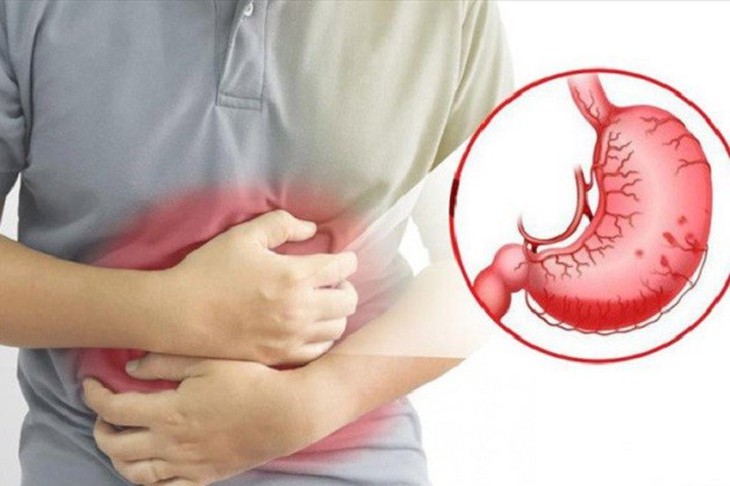 Cách hỗ trợ trị viêm loét dạ dày tại nhà đơn giản, dễ thực hiện - Ảnh 1. Cách hỗ trợ trị viêm loét dạ dày tại nhà đơn giản, dễ thực hiện - Ảnh 1.