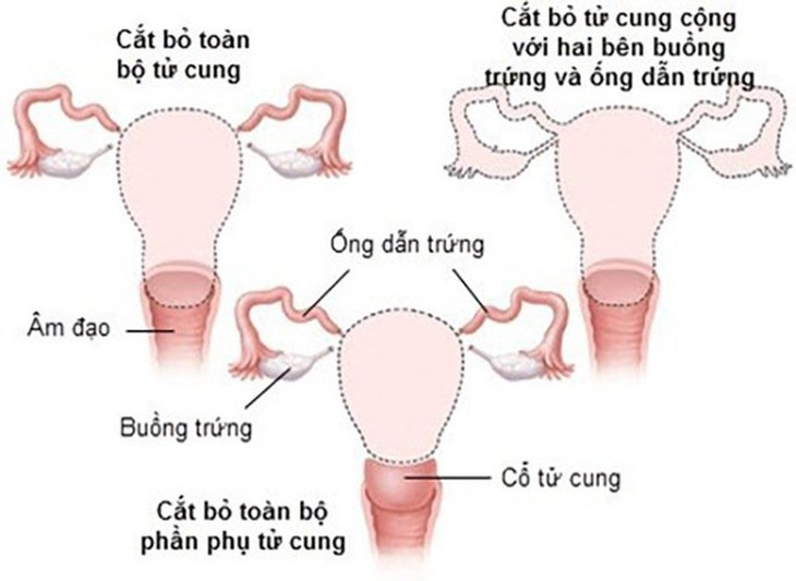 Cắt bỏ tử cung ảnh hưởng đến phụ nữ thế nào? - Ảnh 2. Cắt bỏ tử cung ảnh hưởng đến phụ nữ thế nào? - Ảnh 2.