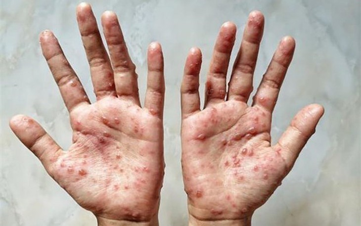 Đã có hơn 15.000 ca bệnh đậu mùa khỉ, WHO ban bố tình trạng khẩn cấp y tế toàn cầu 