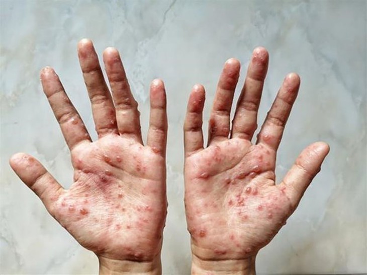 WHO ban bố tình trạng khẩn cấp y tế toàn cầu đối với bệnh đậu mùa khỉ - Ảnh 1. WHO ban bố tình trạng khẩn cấp y tế toàn cầu đối với bệnh đậu mùa khỉ - Ảnh 1.