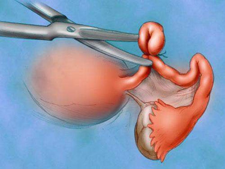Cắt bỏ tử cung có ảnh hưởng đến quan hệ tình dục không? - Ảnh 2.
