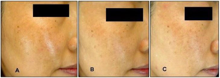 4-n-butylresorcinol có gây kích ứng da? - Ảnh 2.