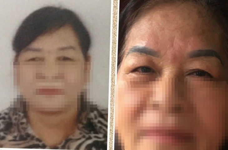 Phẫu thuật lác – không chỉ là nhu cầu thầm mỹ! - Ảnh 2. Phẫu thuật lác – không chỉ là nhu cầu thầm mỹ! - Ảnh 2.