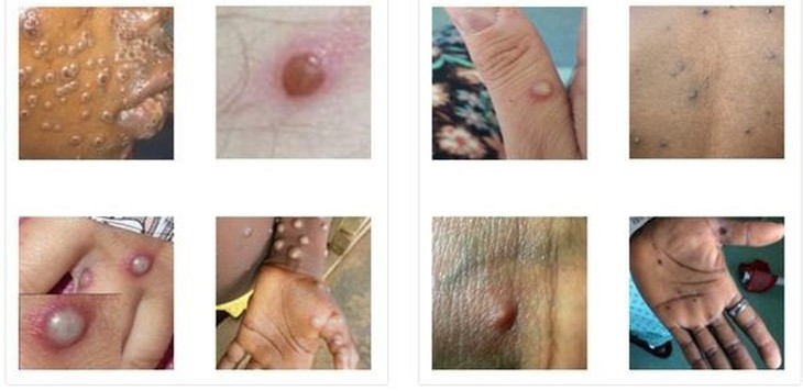 Bộ Y tế họp hội đồng chuyên môn nghiệm thu Hướng dẫn chẩn đoán, điều trị bệnh đậu mùa khỉ - Ảnh 2. Bộ Y tế họp hội đồng chuyên môn nghiệm thu Hướng dẫn chẩn đoán, điều trị bệnh đậu mùa khỉ - Ảnh 2.