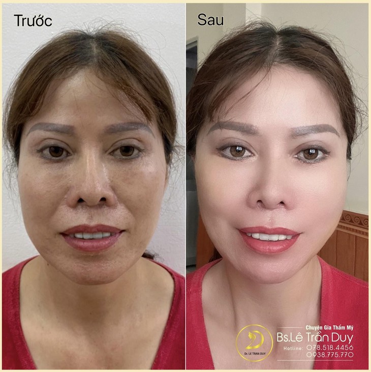 Căng da mặt bằng chỉ xóa nhăn da ở bác sĩ tài năng - Ảnh 2.