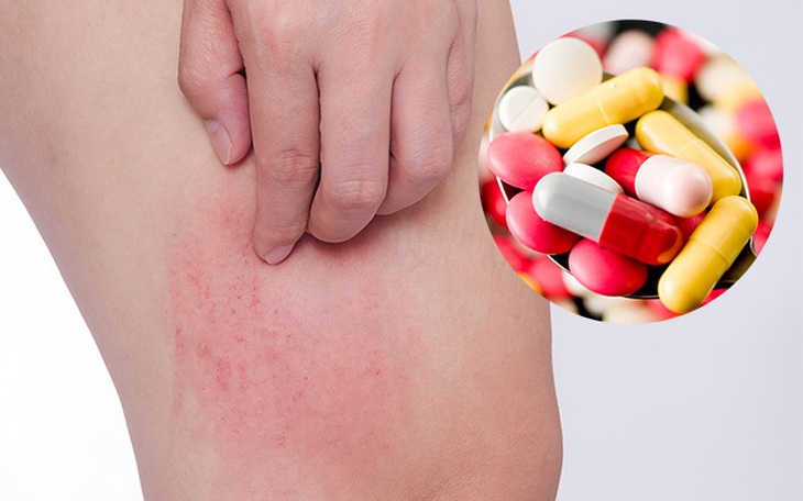 Nguy cơ dị ứng thuốc - cách nào khắc phục?