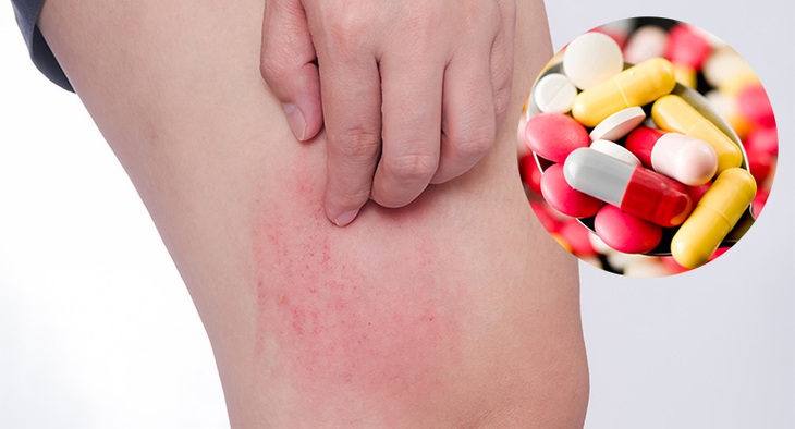 Nguy cơ dị ứng thuốc – cách nào khắc phục - Ảnh 1.