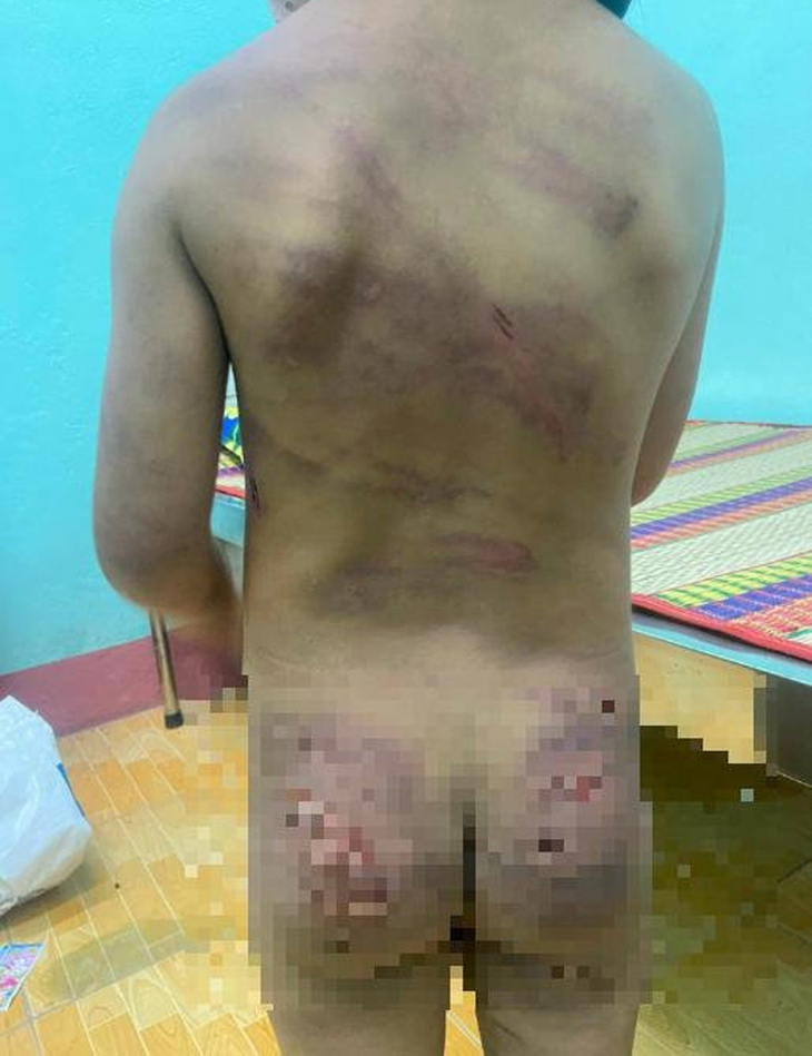 Vụ bé gái 7 tuổi bị bạo hành: Bị cha dượng đánh dã man vì làm đổ cơm khi ăn - Ảnh 3. Vụ bé gái 7 tuổi bị bạo hành: Bị cha dượng đánh dã man vì làm đổ cơm khi ăn - Ảnh 3.
