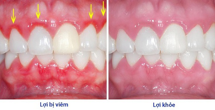 5 Bài thuốc điều trị viêm nha chu - Ảnh 1.