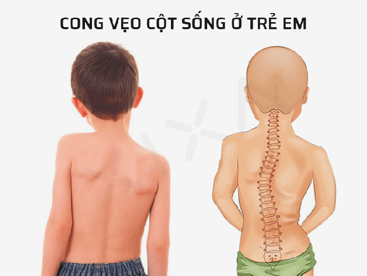 Những yếu tố nguy cơ gây gù vẹo cột sống ở trẻ em cha mẹ cần biết - Ảnh 2.