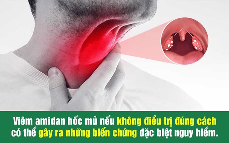 Viêm amidan hốc mủ: Điều trị càng muộn càng nguy hiểm