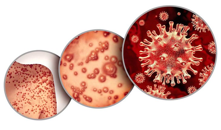 Bệnh đậu mùa khỉ: Con đường lây truyền và biện pháp có thể ngăn ngừa nhiễm virus - Ảnh 4. Bệnh đậu mùa khỉ: Con đường lây truyền và biện pháp có thể ngăn ngừa nhiễm virus - Ảnh 4.