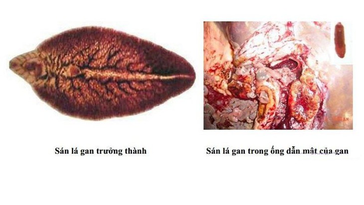 Đầy bụng, buồn nôn, chóng mặt là những biểu hiện triệu chứng của sản lá gan.