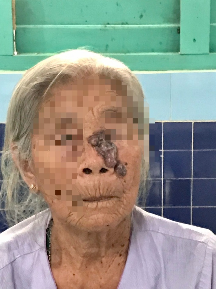 Phẫu thuật cắt khối u, ghép da mặt cho bệnh nhân ung thư da 87 tuổi - Ảnh 1.