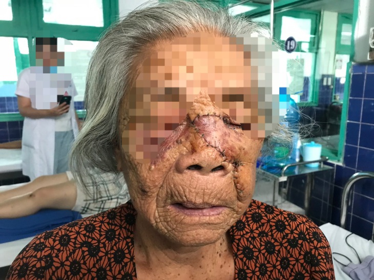 Phẫu thuật cắt khối u, ghép da mặt cho bệnh nhân ung thư da 87 tuổi - Ảnh 2.