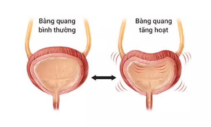Tiểu nhiều, tiểu đêm,… cảnh giác với hội chứng bàng quang tăng hoạt - Ảnh 2. Tiểu nhiều, tiểu đêm,… cảnh giác với hội chứng bàng quang tăng hoạt - Ảnh 2.